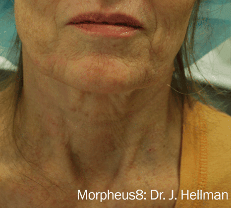 Acne Scar Reduction - After