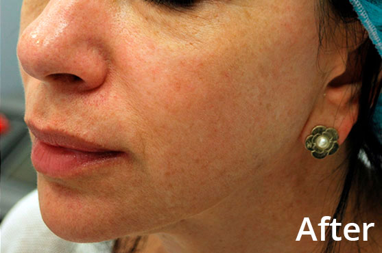 Nasolabial Folds & Skin Texture - After