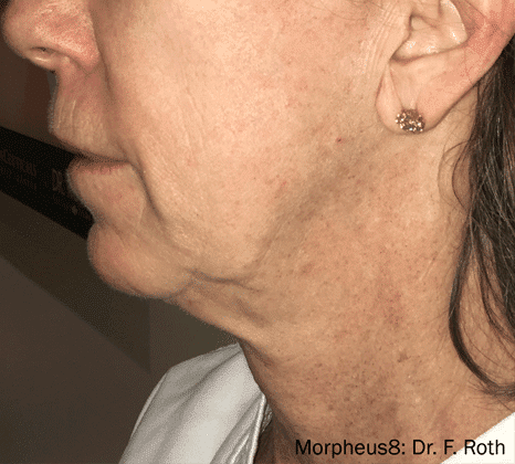 Jawline & Jowl Tightening - After