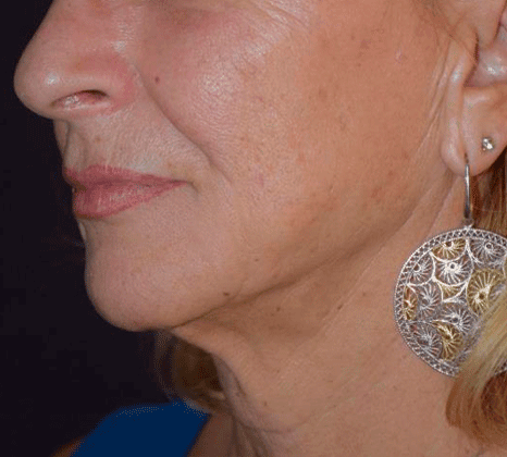 Neck Skin Tightening - After