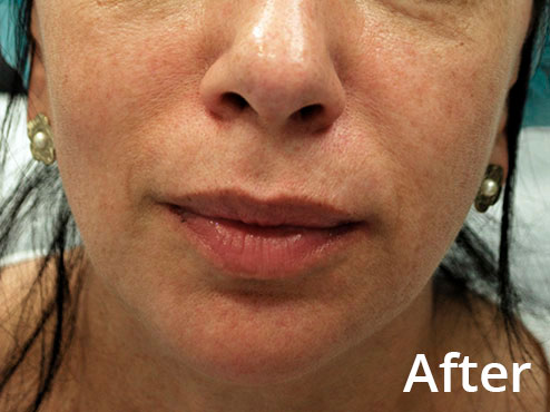 Smile Lines Softening - After