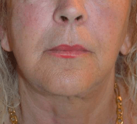 Overall Skin Texture - After